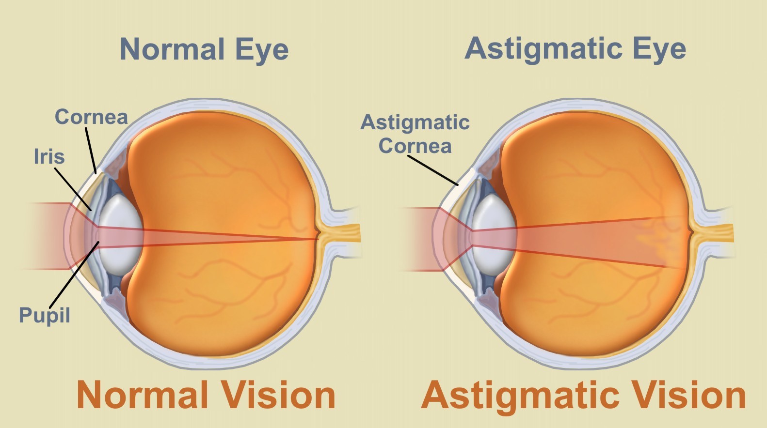  What Is Astigmatism New Health Guide