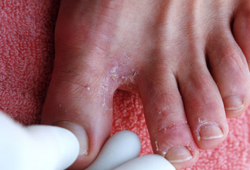 Fungal Skin Infections New Health Guide