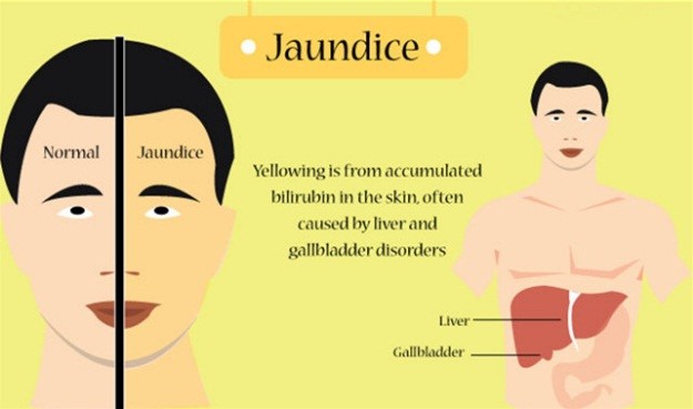 What Causes Jaundice New Health Guide