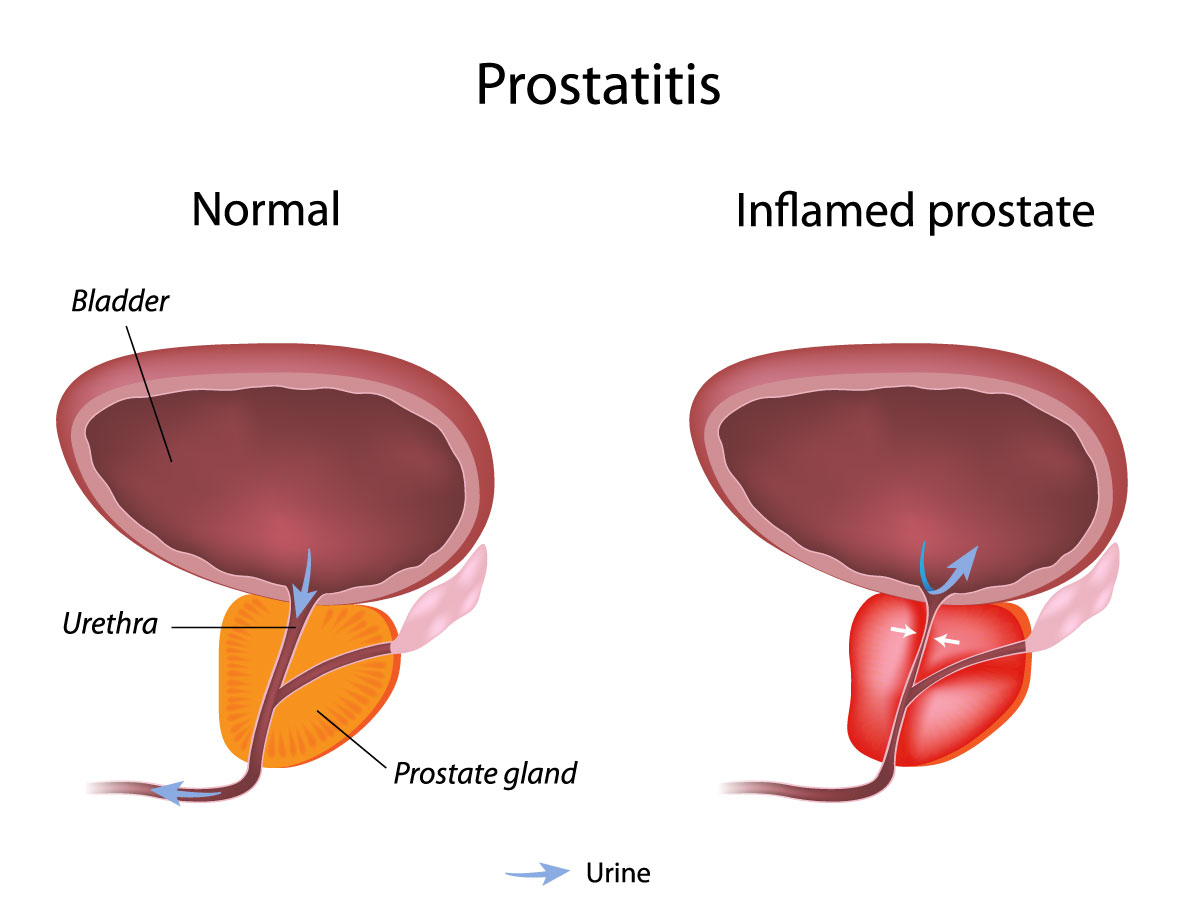 Chronic Prostatitis New Health Guide