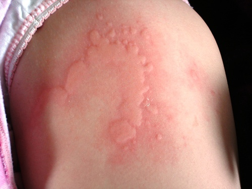 Itchy Rash In Children New Health Guide