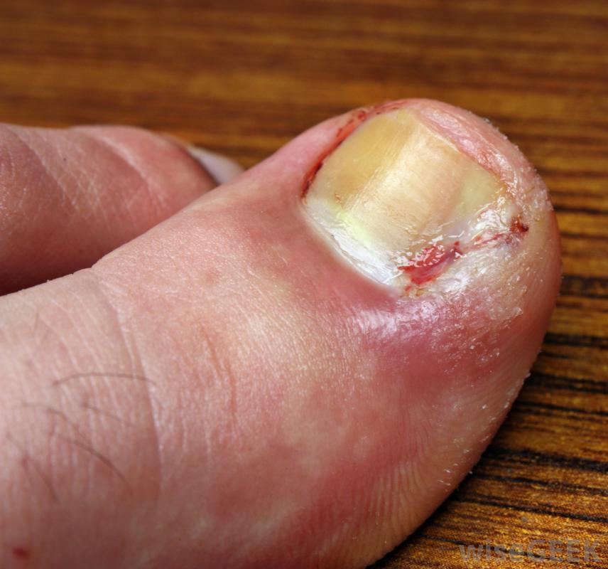 6 Reasons Why Your Toenails Turn White New Health Guide